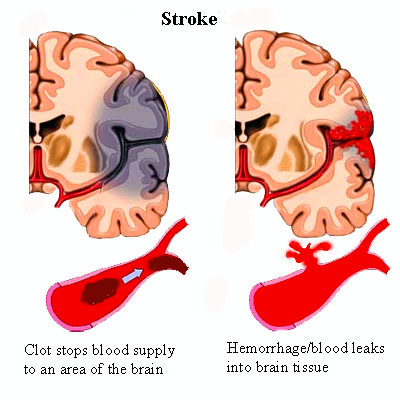 stroke